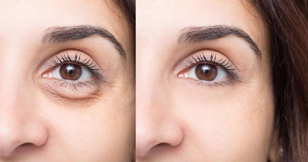 Dacă te trezești cu ochii umflați dimineața, iată adevăratul motiv și ce spune un dermatolog că trebuie să faci