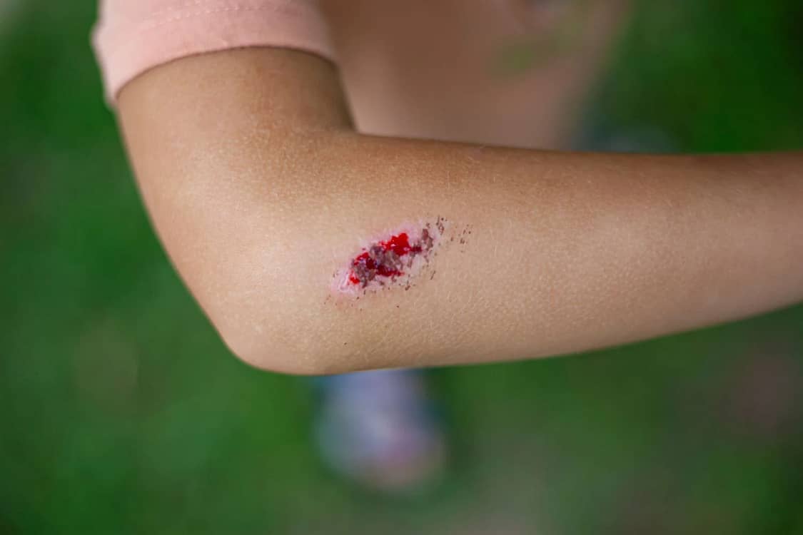 Rănile nu pot fi considerate banale când există riscul de contaminare cu spori FOTo. Shutterstock