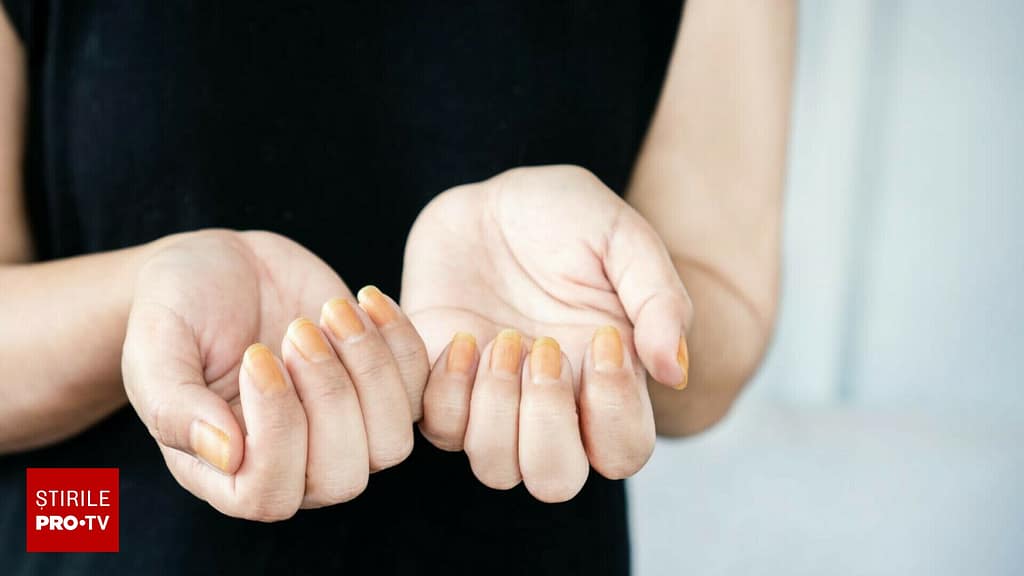 Dieta extremă care duce la îngălbenirea unghiilor și putrezirea dinților. O adeptă de 27 de ani, găsită moartă într-un hotel