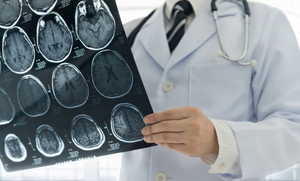 Studiu alarmant: 1 din 5 pacienți cu AVC minor va suferi un nou accident vascular cerebral în următorii 10 ani