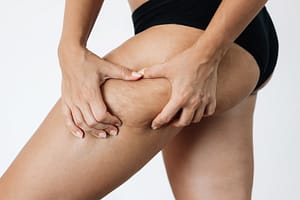 Celulita începe din farfurie. Ce alimente o favorizează fără să știi